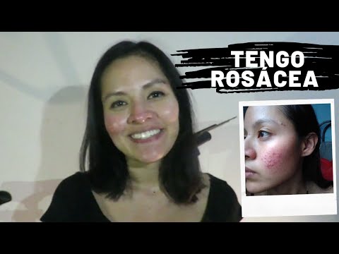 Tipos de tratamientos para el acné pápulo-pustuloso