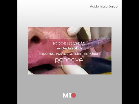 Técnica blanching, lo nuevo para atenuar arrugas finas Técnica blanching, lo nuevo para atenuar arrugas finas