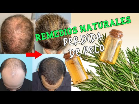 7 remedios para tratar la alopecia de forma natural