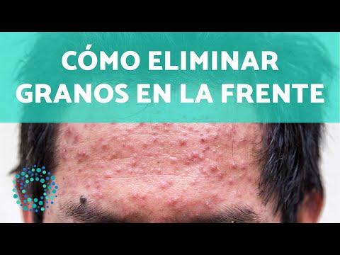 ¿Por qué me salen granos en la frente y cómo puedo eliminarlos?