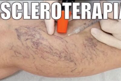Tratamiento de varices con microespuma