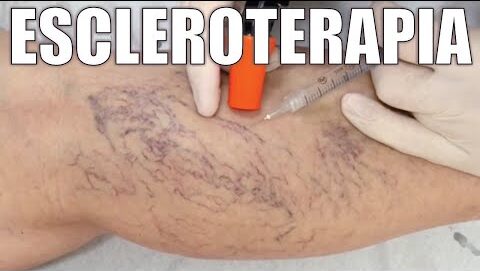 Tratamiento de varices con microespuma
