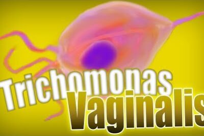 Tricomoniasis femenina: ¿se puede abordar con remedios naturales?